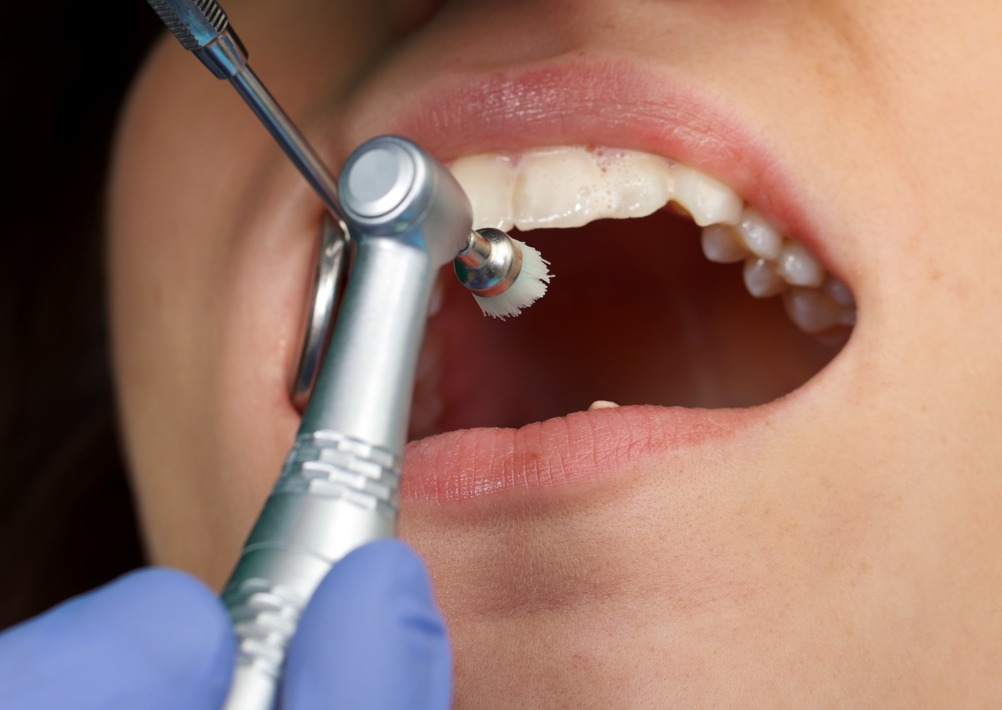 Oral Prophylaxis (Cleaning)