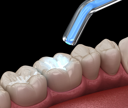 Restoration (Filling)