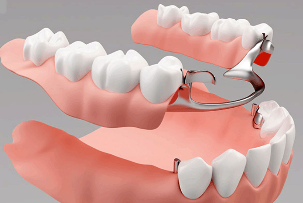 Denture (Removable)