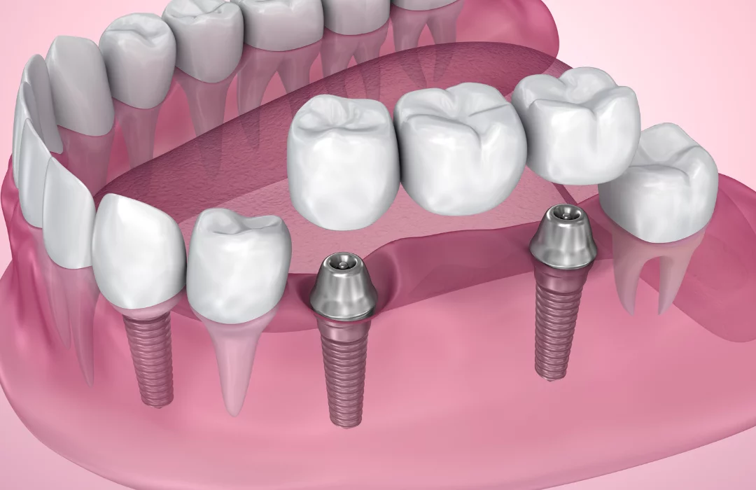 Fixed Prosthesis (Bridge)