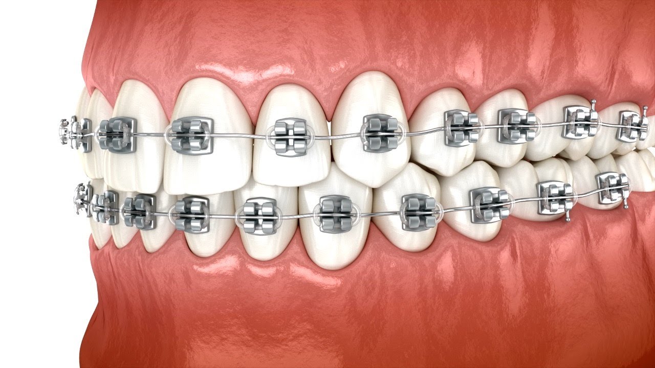 Braces (Initial Placement)