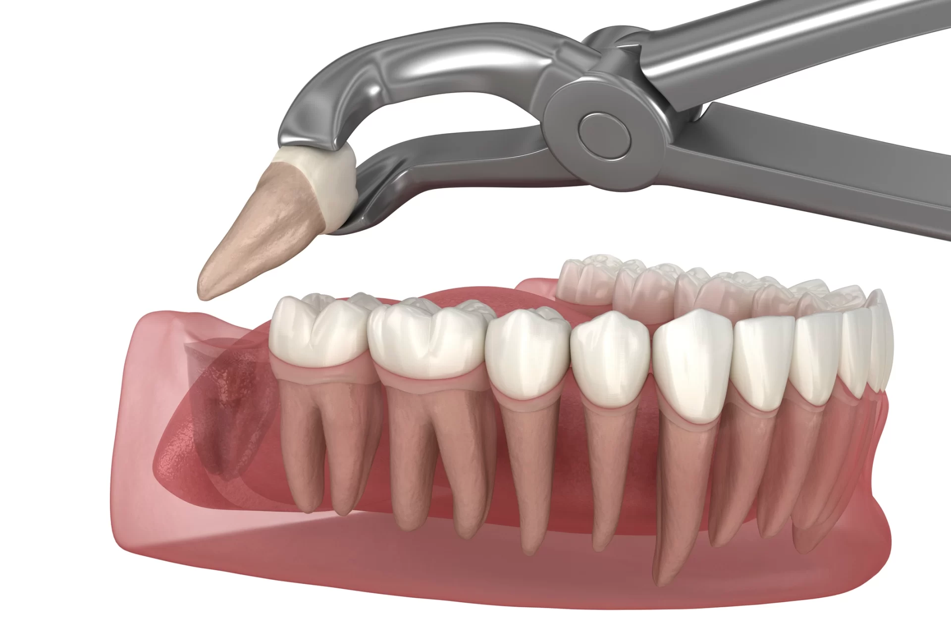 Wisdom Tooth Surgery